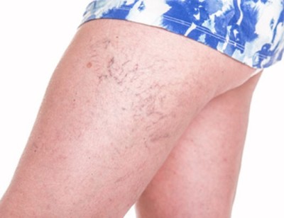 sclerotherapy