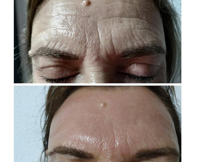 tratamiento-facial-benissa-DERMA-IR